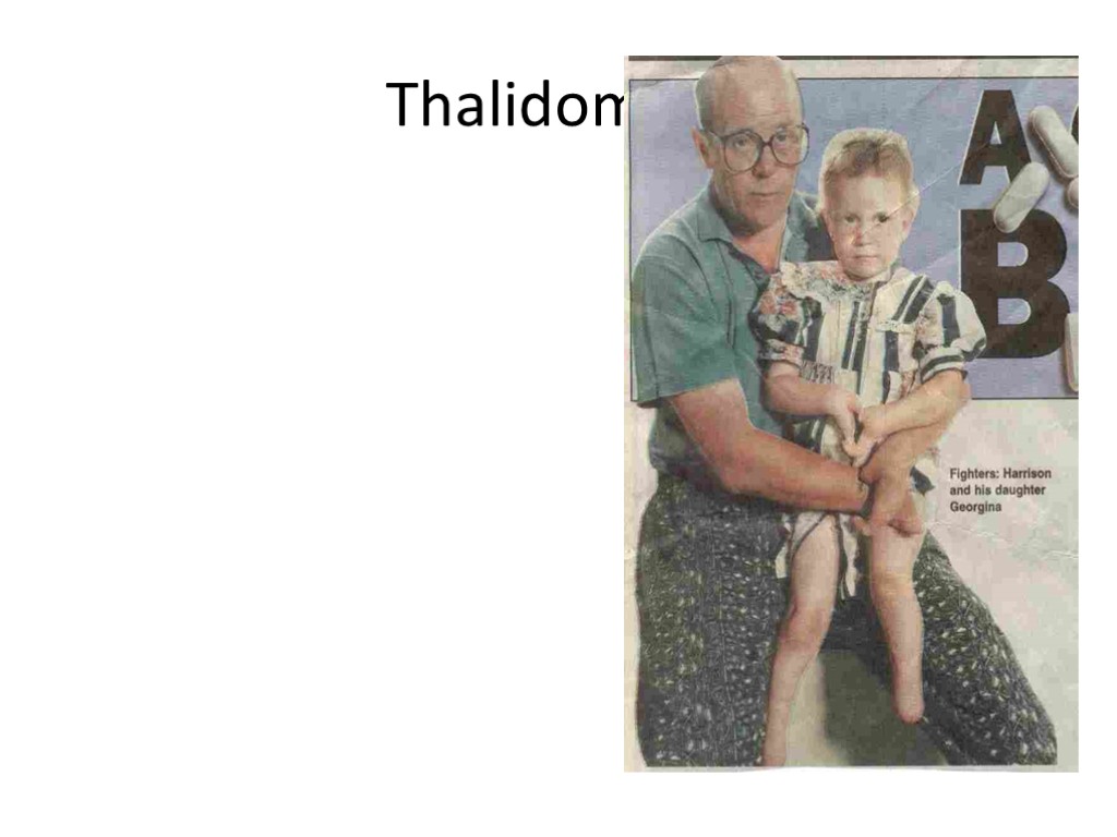 Thalidomide Early 1960’s given to pregnant women to treat morning sickness Later found to